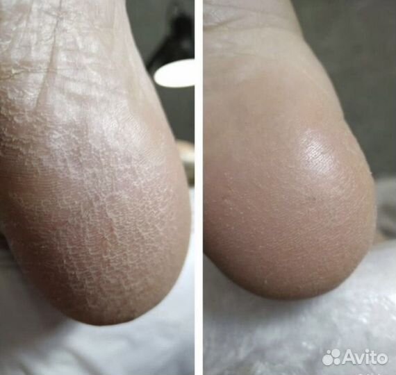 Медицинский педикюр. Подолог