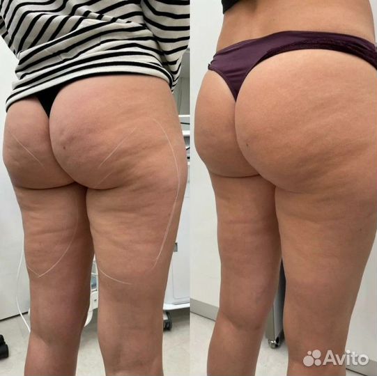 Массажист / lpg массаж