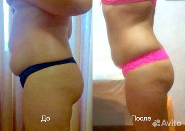 Вакуумно - роликовый массаж