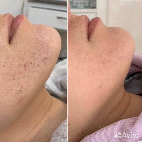 Карбоновый пилинг лица -50%