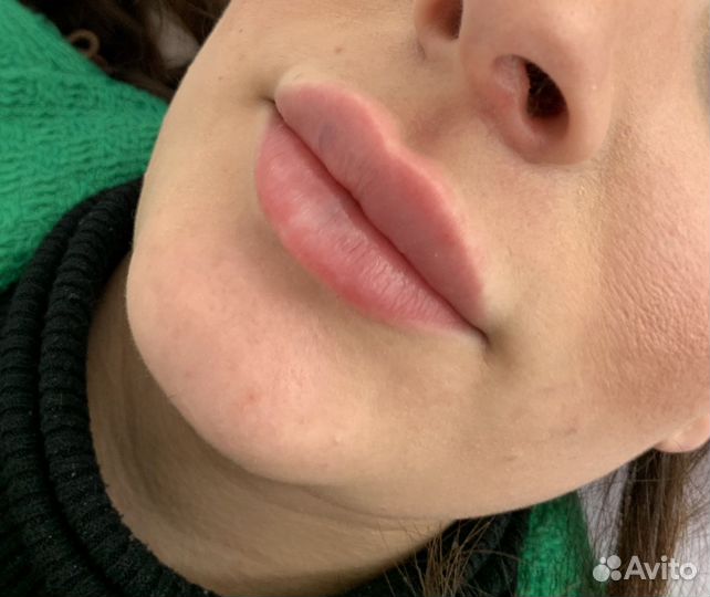 Увеличение губ модель