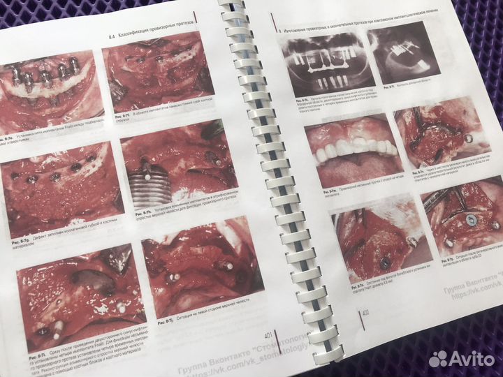 Регенеративные методы в имплантологии