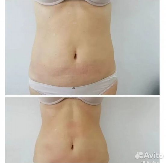 Плоский живот - размер за 1 процедуру в Курске