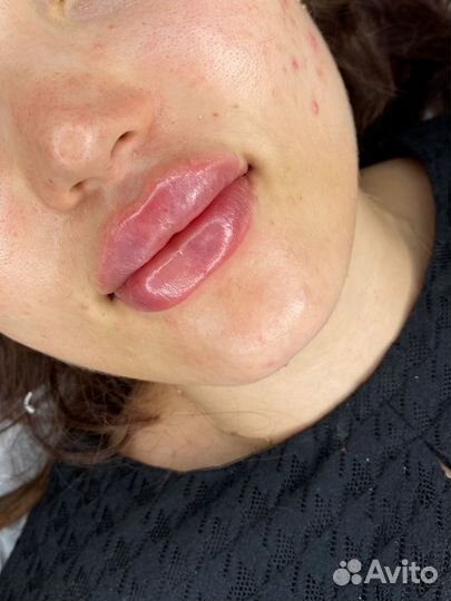 Ботулинотерапия