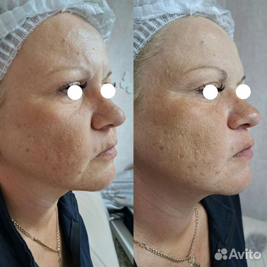 Процедура SMAS лифтинг