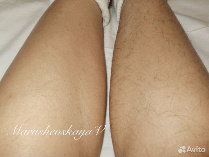 Электроэпиляция для мужчин и женщин