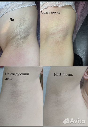 Электроэпиляция юмр