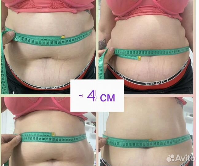 Похудение для мужчин и женщин Криолиполиз Москва