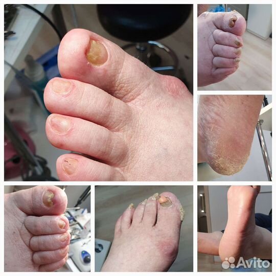 Педикюр, подология