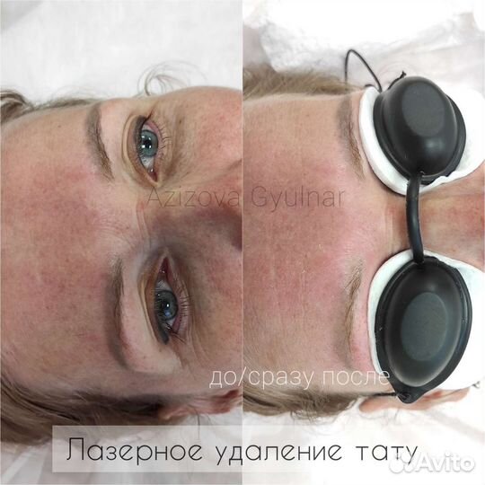 Удаление тату/перманента/татуировок/татуажа бровей