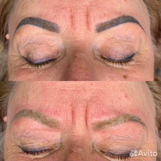 Удаление татуажа и татуировок в Благовещенске