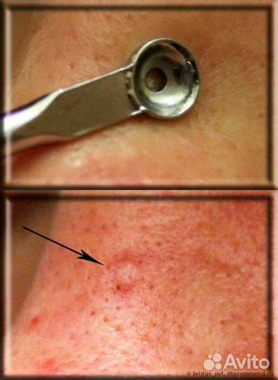 Инструмент для удаления прыщей