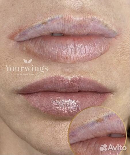 Удаление татуажа ремувером