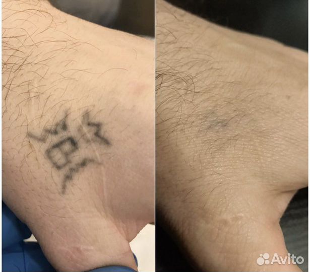 Лазерное удаление татуировок