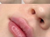 Увеличение губ, носогубка, врач-косметолог