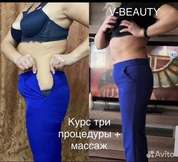 Криолиполиз New система липосакции