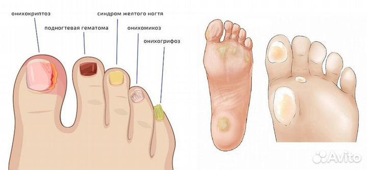 Подолог,медицинский педикюр с выездом и в салоне