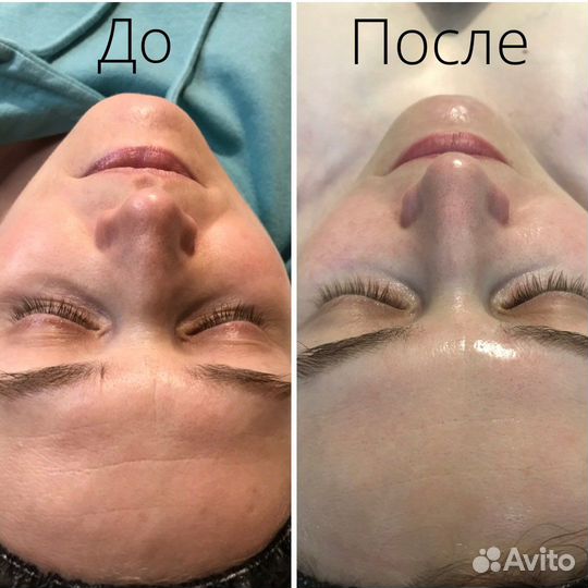 Комбинированная чистка лица