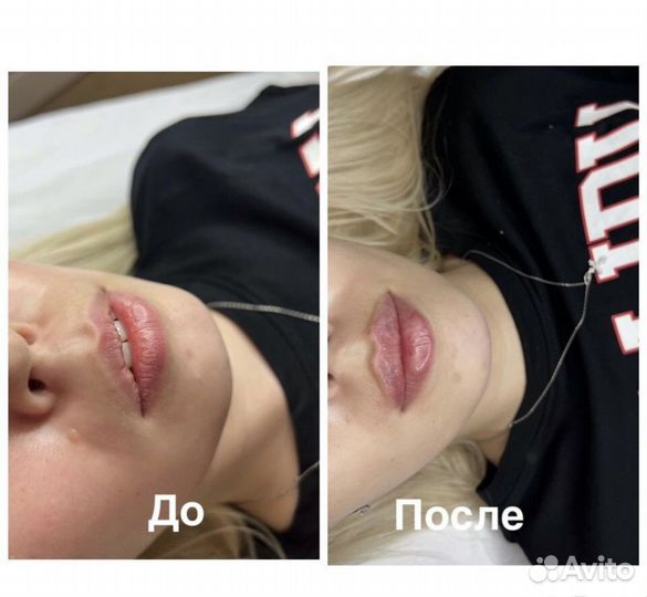 Увеличение губ