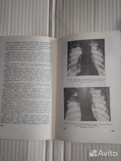 Туберкулёз легких в возрасте от 50 лет