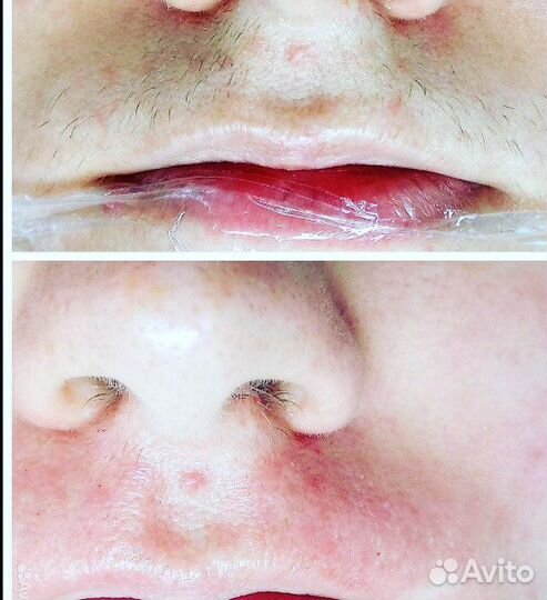 Электроэпиляция