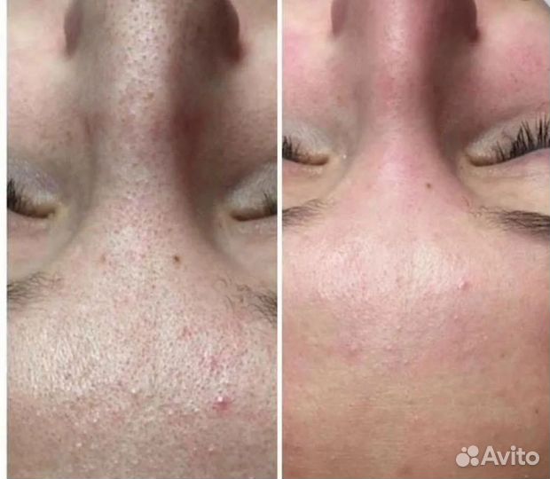 Карбоновый пилинг аппарат