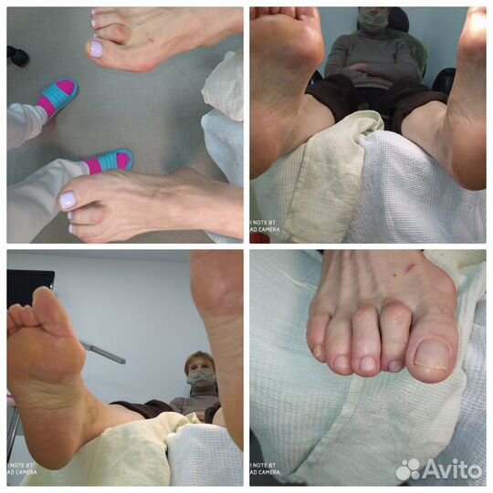 Подолог проблемный педикюр протезирование скоба