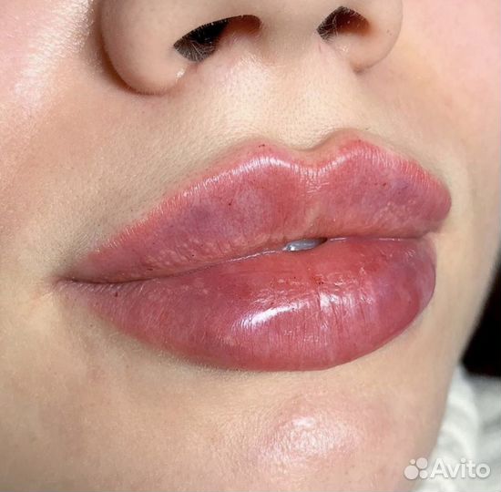 Увеличение губ