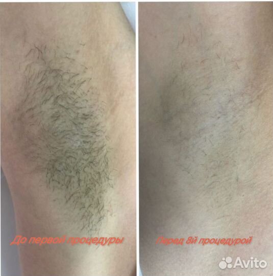 Электроэпиляция Apilus, Обучение электроэпиляции