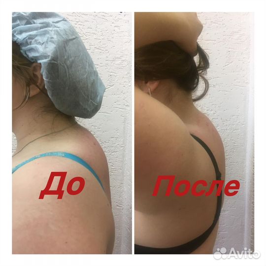 LPG массаж, вакуумный, уз-липосакция, RF-лифтинг