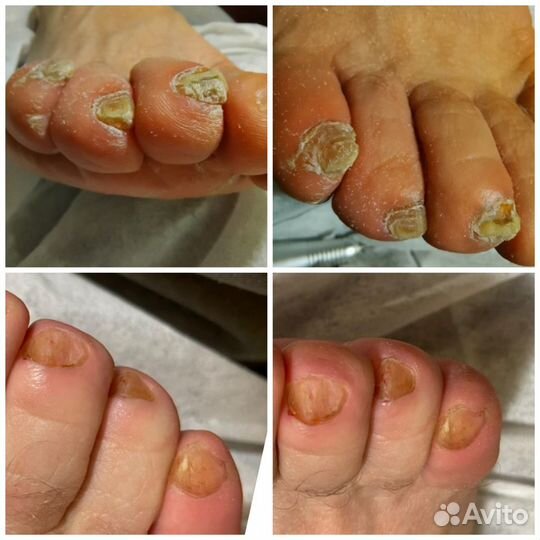 Подолог. Медицинский педикюр.Сергиев Посад