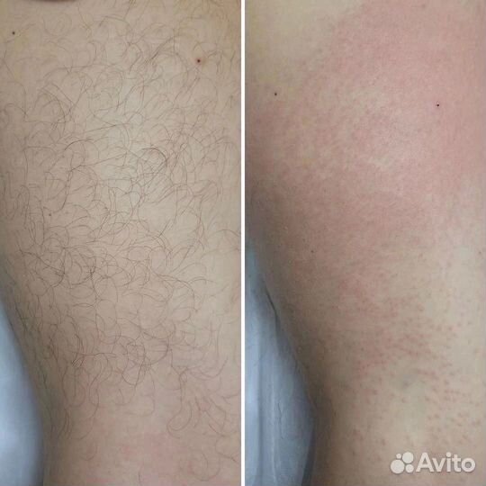 Электроэпиляция