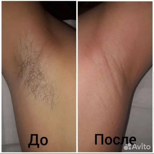 Депиляция, шугаринг