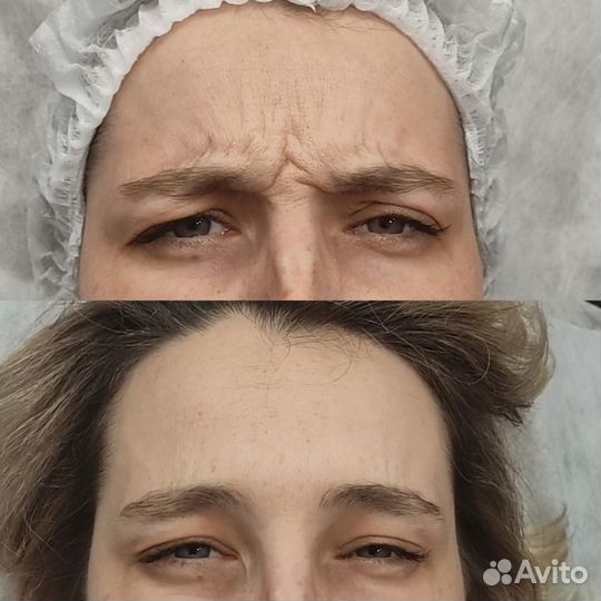 Модель на ботокс лица