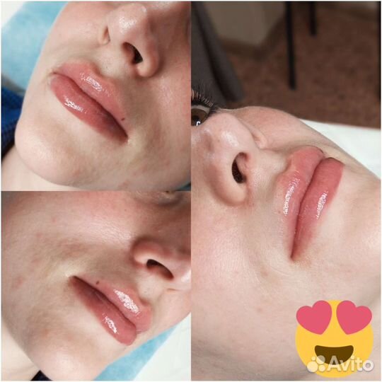 Увеличение губ