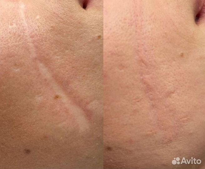 Камуфляж шрамов, ореол. Перекрытие татуажа