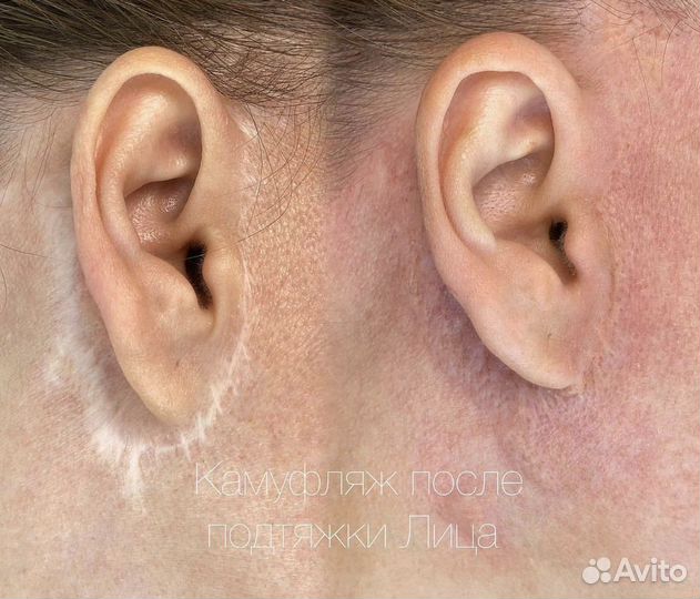 Камуфляж шрамов / рубцов (перманент )