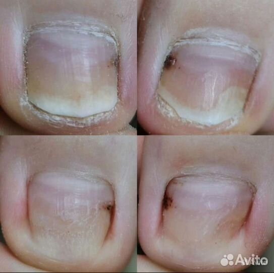 Педикюр, титановая нить, вросшие ногти, онихолизис