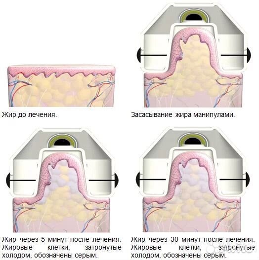 Криолиполиз (Похудение)