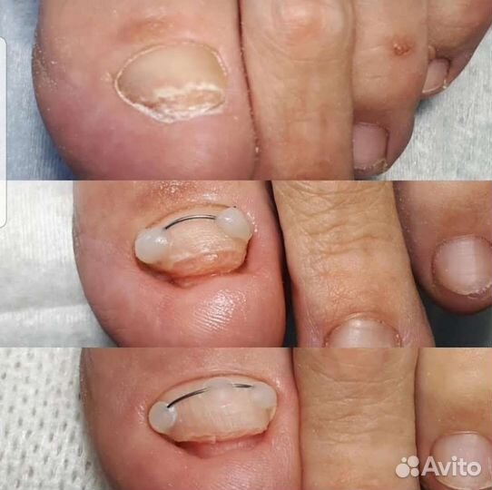 Аппаратный педикюр