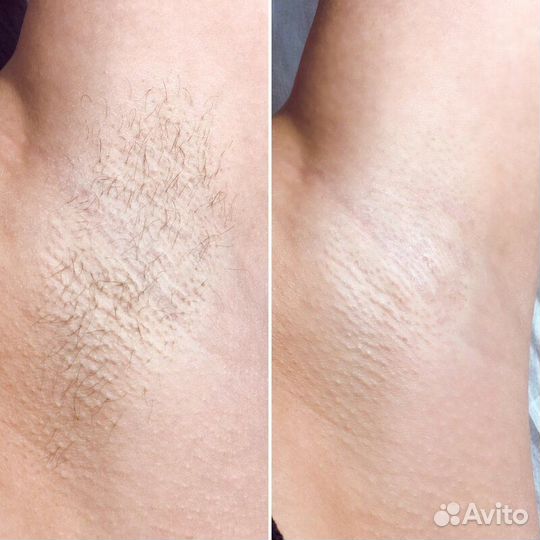 Шугаринг депиляция