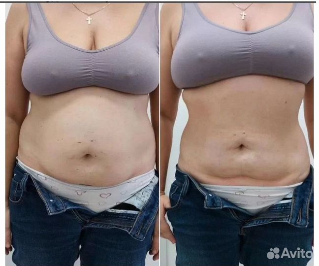 Липосакция без операции в Кирове