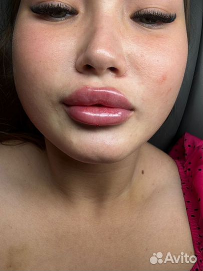 Увеличение губ