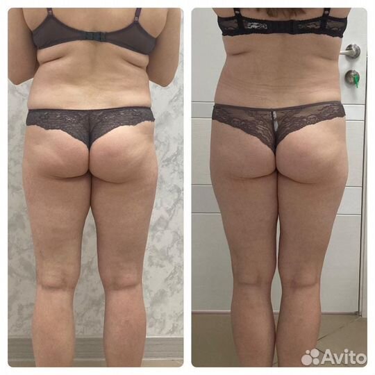 LPG, прессотерапия