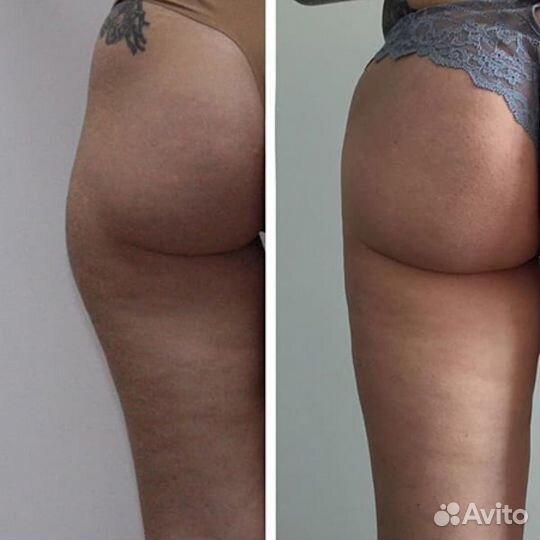 Модели на Кавитация Бедер