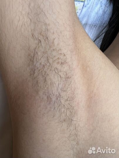 Электроэпиляция