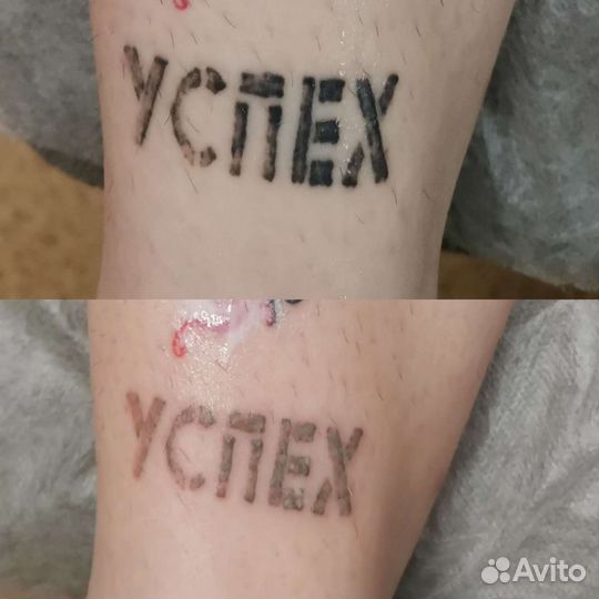 Лазерное удаление Тату, Татуажа, Карбоновый пилинг