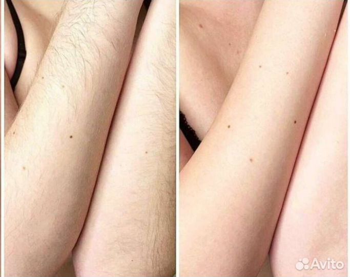 Фотоэпиляция