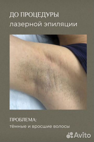 Лазерная эпиляция