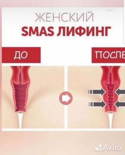 Интимное омоложение